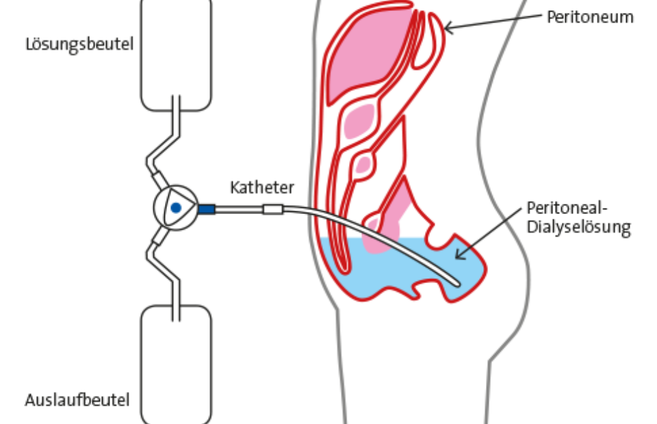 Grafik peritonealdialyse