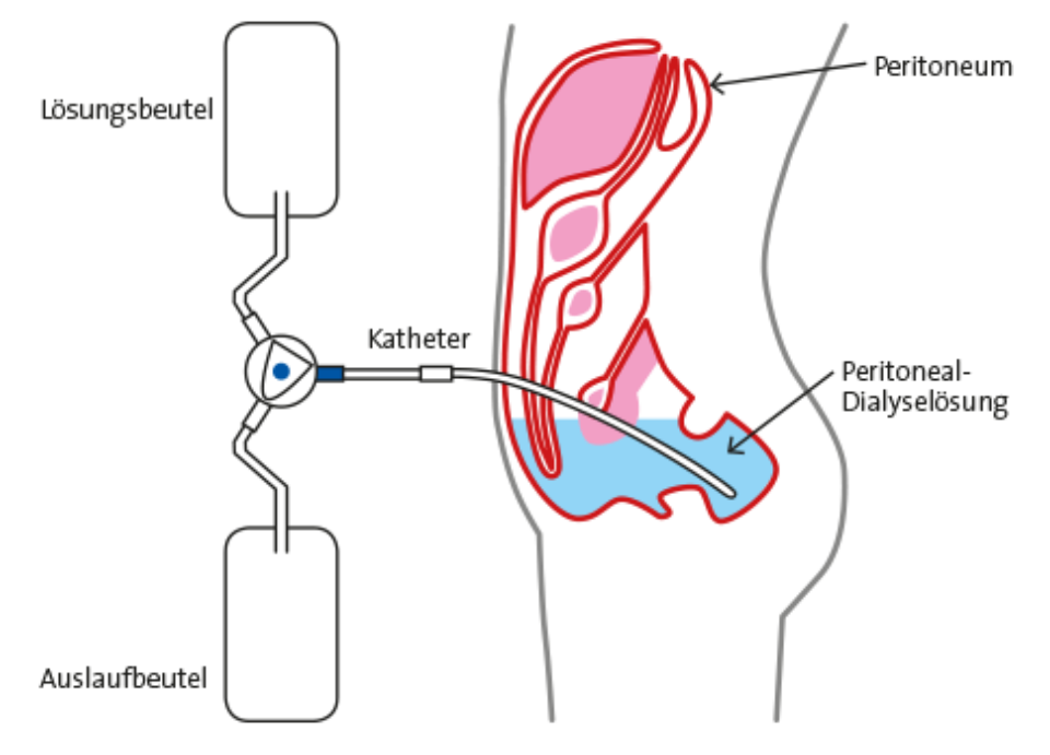 Grafik peritonealdialyse