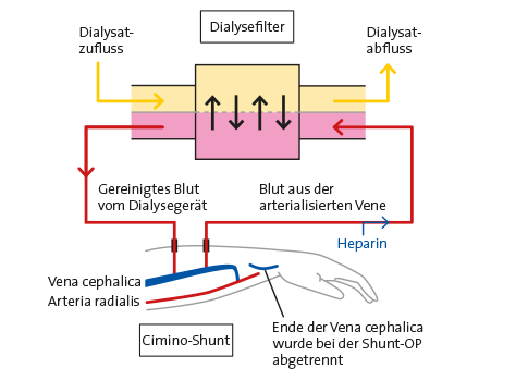 Grafik haemodialyse