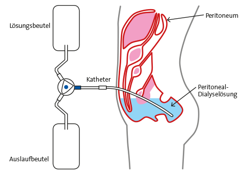 Grafik peritonealdialyse